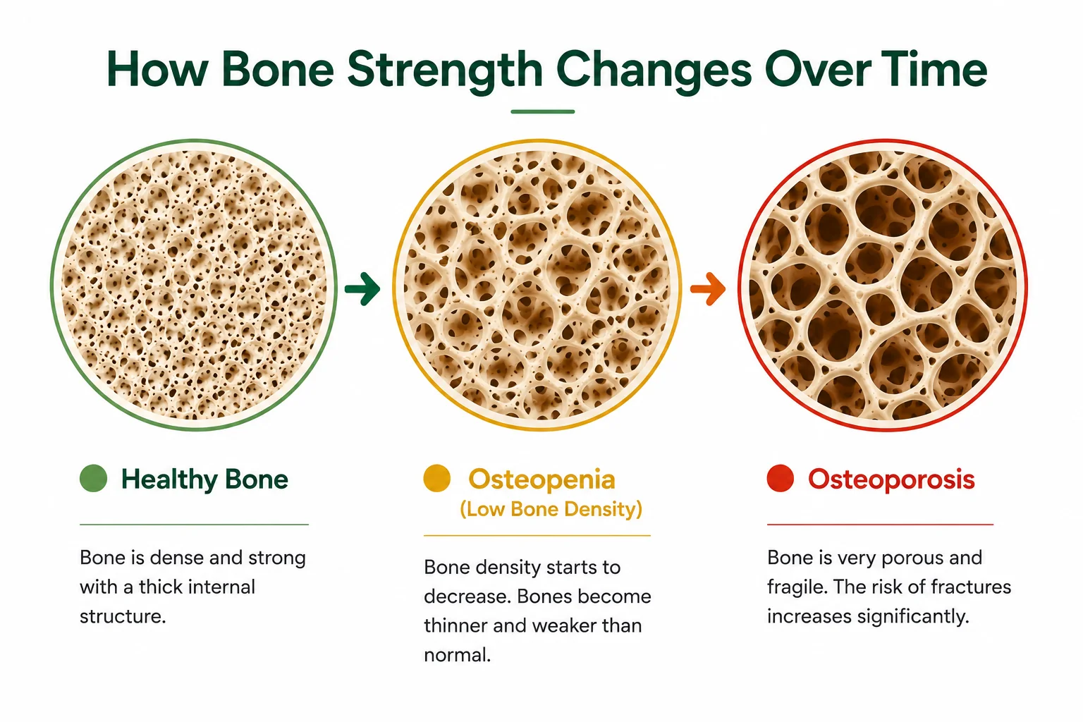 Illustration comparing healthy bone, osteopenia and osteoporosis, showing how bone density decreases and bones become more porous over time.