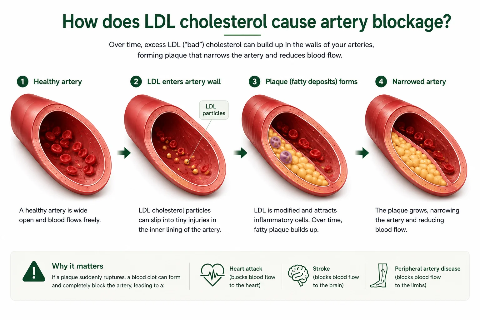Medical illustration showing how LDL cholesterol enters the artery wall, forms plaque over time, narrows the artery, and increases the risk of heart attack and stroke.